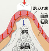 歯ぐきの骨（歯槽骨）がやせ細る原因